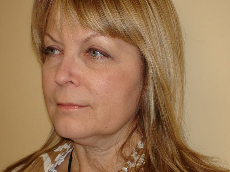 Mini-Facelift Before & After Gallery - Patient 133066505 - Image 3