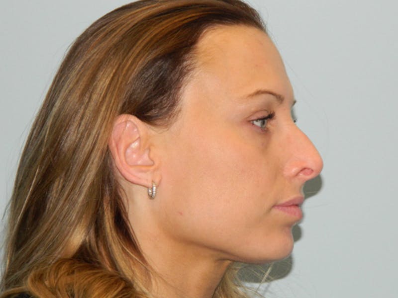 Rhinoplasty Before & After Gallery - Patient 133066521 - Image 1