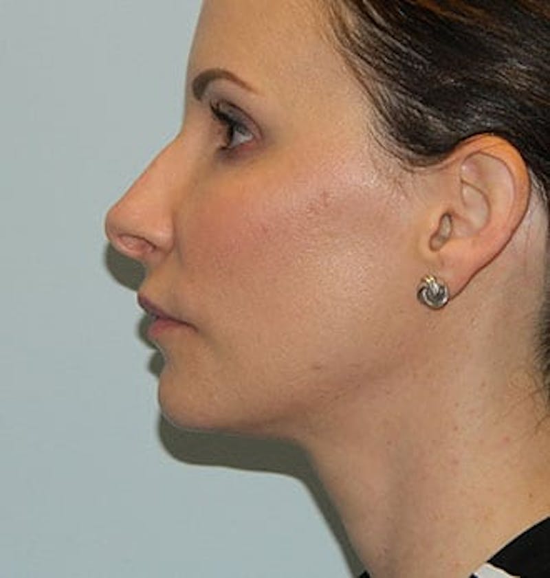 Revision Rhinoplasty Before & After Gallery - Patient 133066517 - Image 1