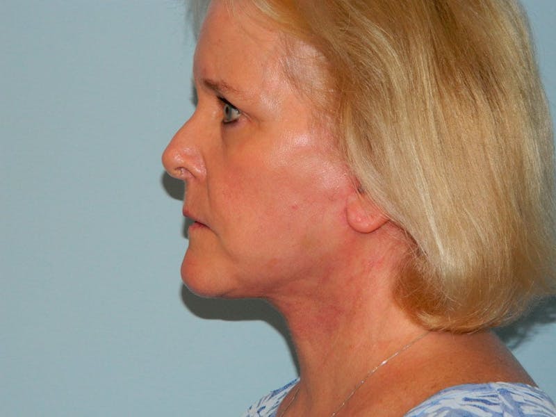Facelift Before & After Gallery - Patient 133066501 - Image 6