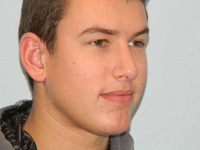 Chin Augmentation Before & After Gallery - Patient 133066499 - Image 6