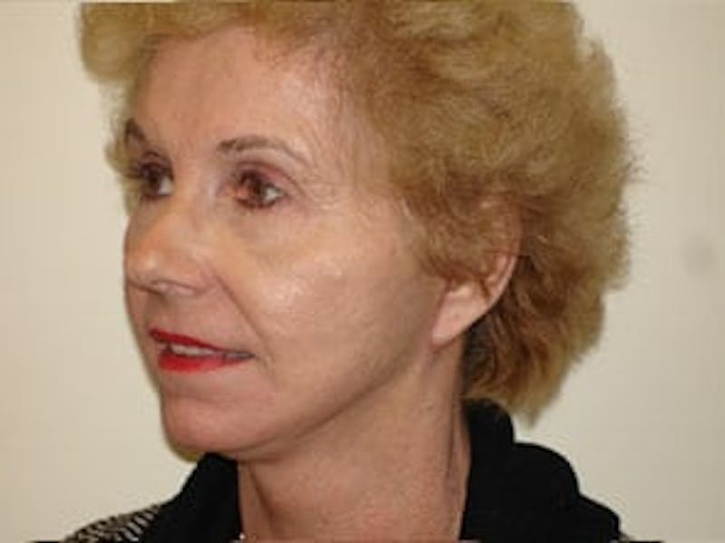 Fraxel Laser Resurfacing Before & After Gallery - Patient 133066500 - Image 4