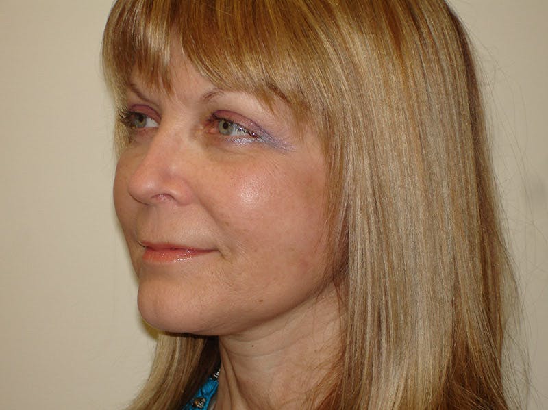 Mini-Facelift Before & After Gallery - Patient 133066505 - Image 4