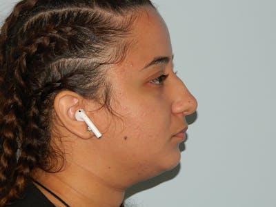 Non-Surgical Rhinoplasty and Injectable Fillers Before & After Gallery - Patient 133066514 - Image 1