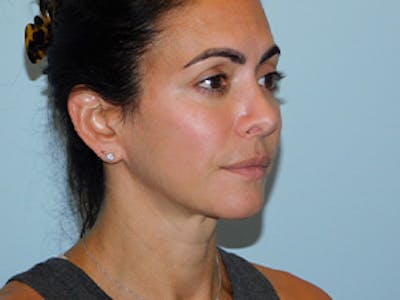 Ultherapy Before & After Gallery - Patient 133066502 - Image 2