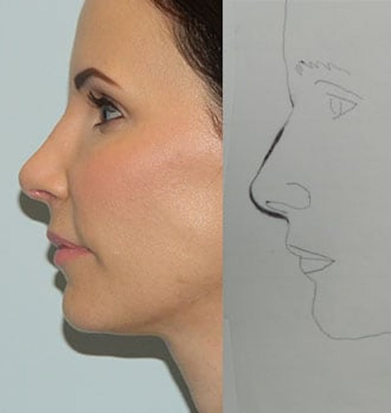Revision Rhinoplasty Before & After Gallery - Patient 133066517 - Image 2
