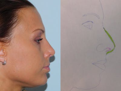 Rhinoplasty Before & After Gallery - Patient 133066521 - Image 2