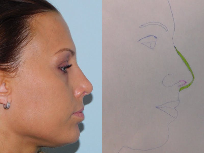 Rhinoplasty Before & After Gallery - Patient 133066521 - Image 2