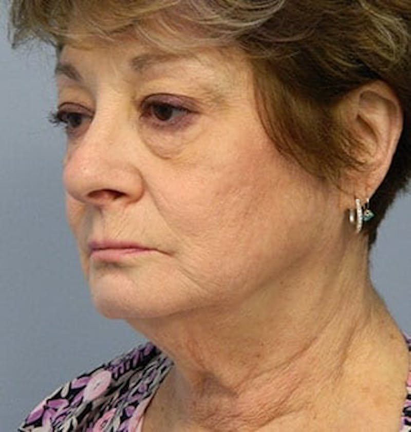Facelift Before & After Gallery - Patient 133066518 - Image 1