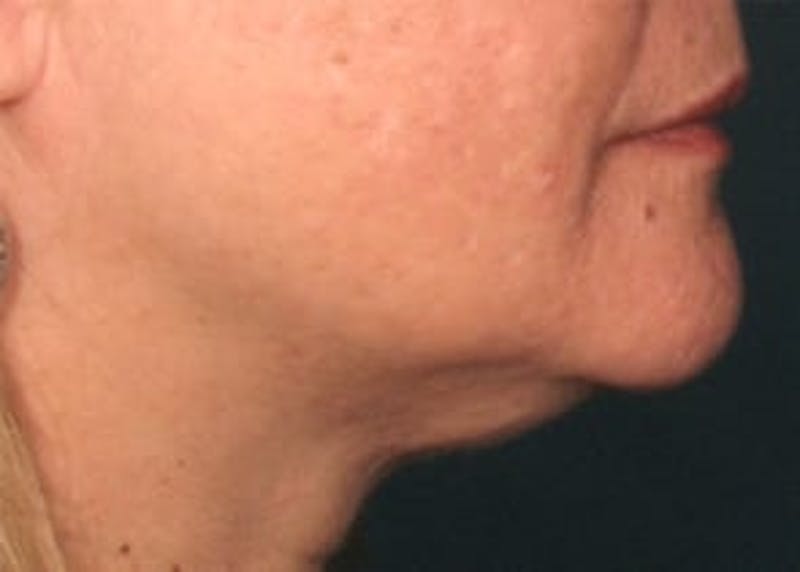 Ultherapy Before & After Gallery - Patient 133066504 - Image 1