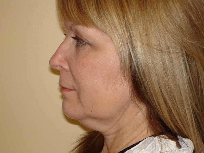 Mini-Facelift Before & After Gallery - Patient 133066505 - Image 5