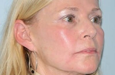 Fraxel Laser Resurfacing Before & After Gallery - Patient 133066503 - Image 2