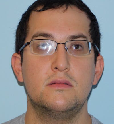 Chin Augmentation Before & After Gallery - Patient 133066520 - Image 2