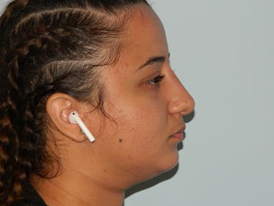 Non-Surgical Rhinoplasty and Injectable Fillers Before & After Gallery - Patient 133066514 - Image 2