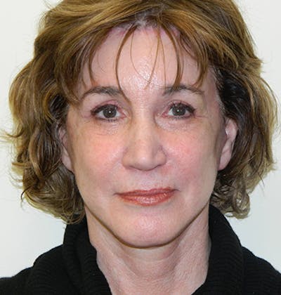 Blepharoplasty (Eyelid Lift) Before & After Gallery - Patient 133066515 - Image 2