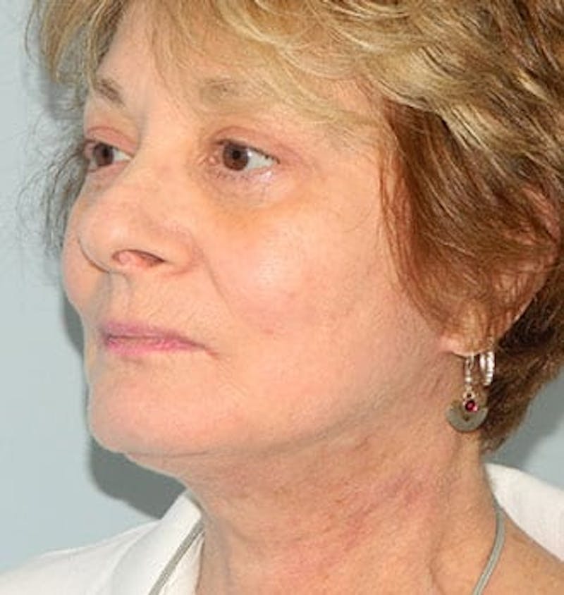 Facelift Before & After Gallery - Patient 133066518 - Image 2