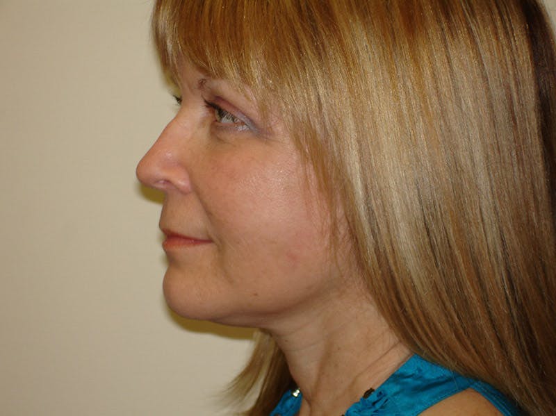Mini-Facelift Before & After Gallery - Patient 133066505 - Image 6