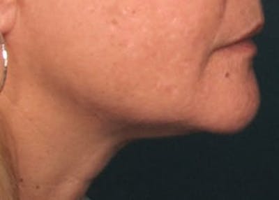 Ultherapy Before & After Gallery - Patient 133066504 - Image 2