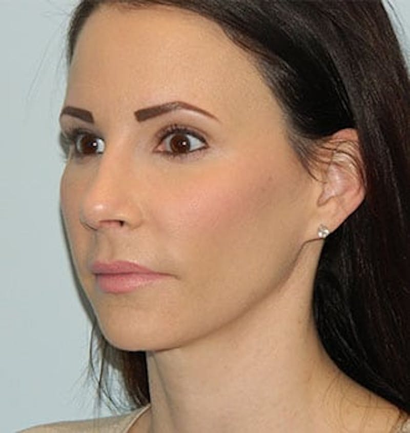Revision Rhinoplasty Before & After Gallery - Patient 133066517 - Image 4