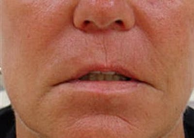 Fraxel Laser Resurfacing Before & After Gallery - Patient 133066516 - Image 1