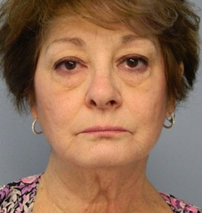 Facelift Before & After Gallery - Patient 133066518 - Image 3