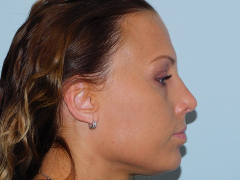Rhinoplasty Before & After Gallery - Patient 133066521 - Image 4