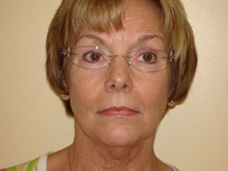 Mini-Facelift Before & After Gallery - Patient 133066522 - Image 1