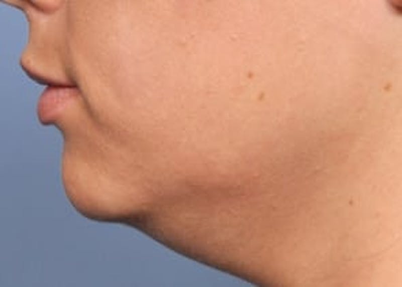 Ultherapy Before & After Gallery - Patient 133066519 - Image 1