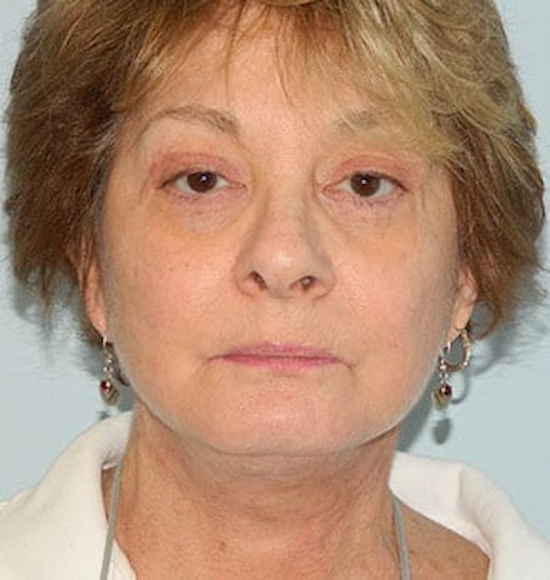 Facelift Before & After Gallery - Patient 133066518 - Image 4