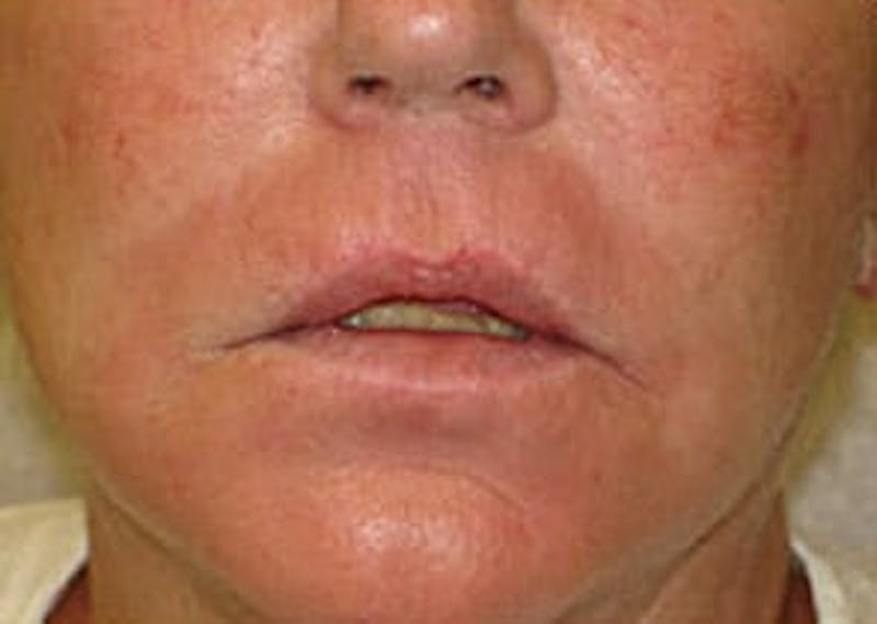 Fraxel Laser Resurfacing Before & After Gallery - Patient 133066516 - Image 2