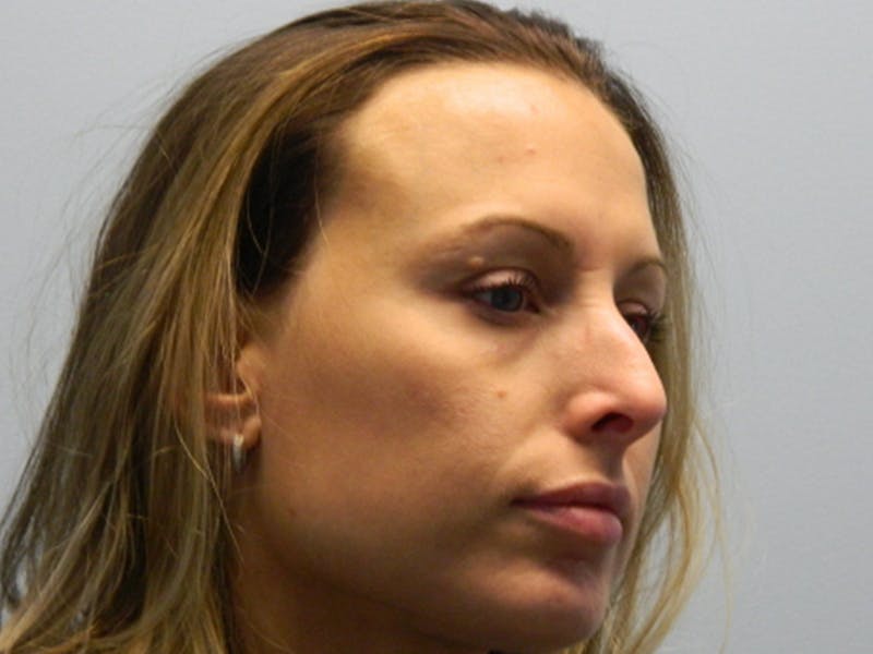 Rhinoplasty Before & After Gallery - Patient 133066521 - Image 5