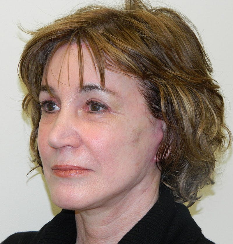 Blepharoplasty (Eyelid Lift) Before & After Gallery - Patient 133066515 - Image 4