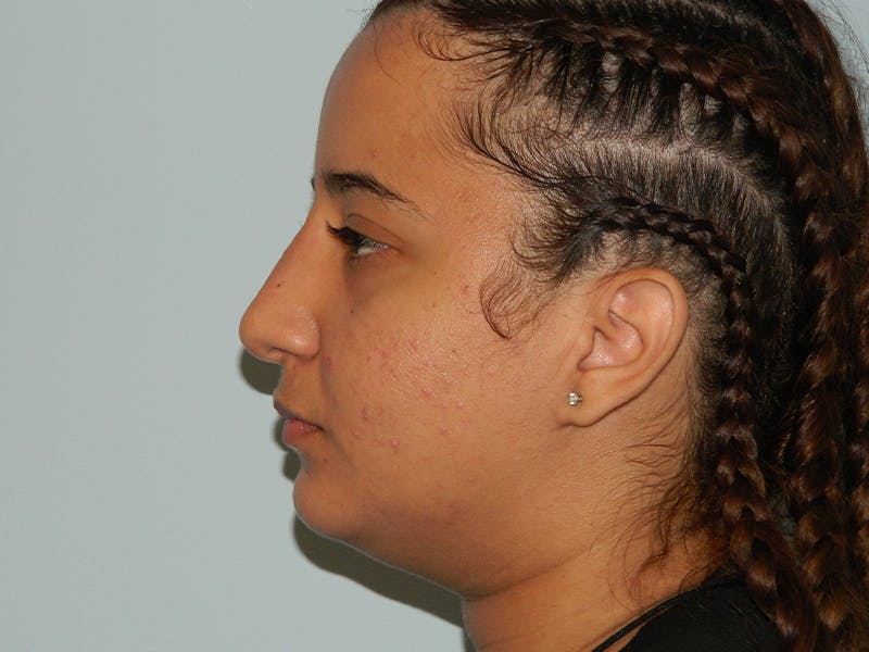 Non-Surgical Rhinoplasty and Injectable Fillers Before & After Gallery - Patient 133066514 - Image 4