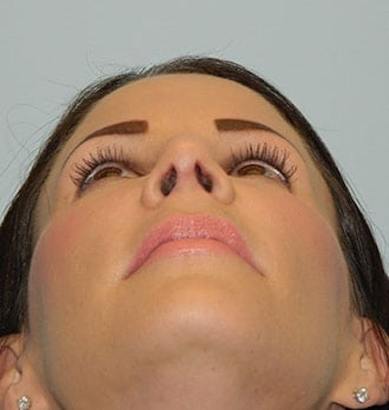 Revision Rhinoplasty Before & After Gallery - Patient 133066517 - Image 6
