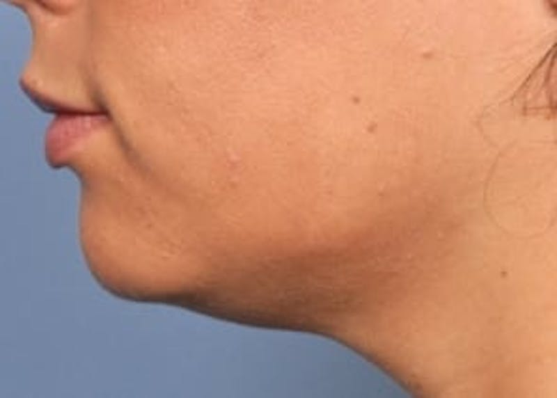Ultherapy Before & After Gallery - Patient 133066519 - Image 2