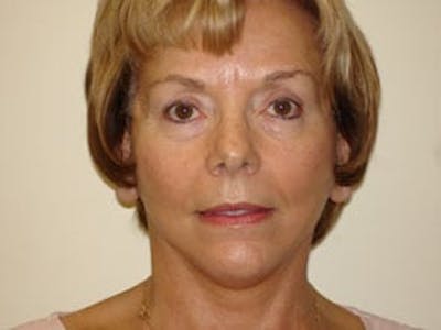 Mini-Facelift Before & After Gallery - Patient 133066522 - Image 2
