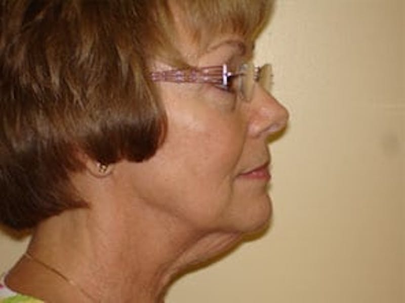 Mini-Facelift Before & After Gallery - Patient 133066522 - Image 3