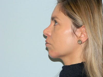 Non-Surgical Rhinoplasty and Injectable Fillers Before & After Gallery - Patient 133066526 - Image 1