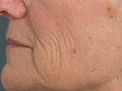 Fraxel Laser Resurfacing Before & After Gallery - Patient 133066523 - Image 1