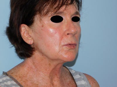 Facelift Before & After Gallery - Patient 133066535 - Image 1