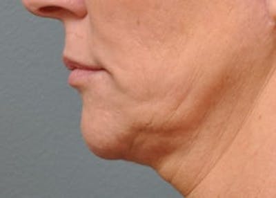 Ultherapy Before & After Gallery - Patient 133066524 - Image 1