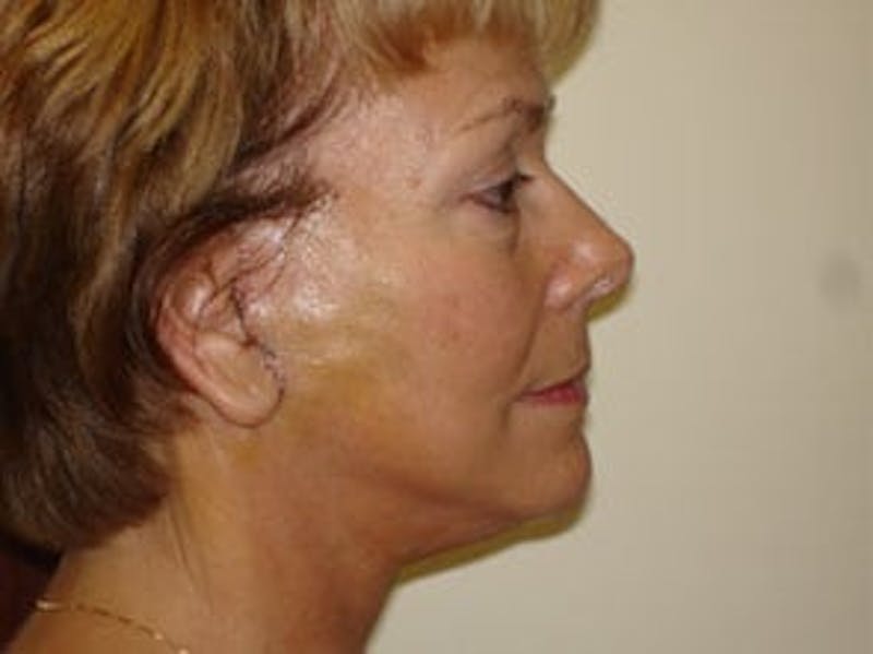 Mini-Facelift Before & After Gallery - Patient 133066522 - Image 4