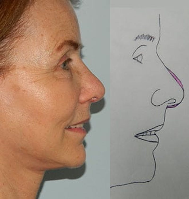 Revision Rhinoplasty Before & After Gallery - Patient 133066525 - Image 2