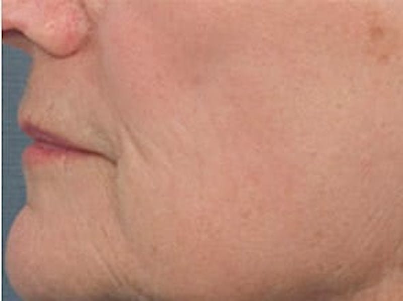 Fraxel Laser Resurfacing Before & After Gallery - Patient 133066523 - Image 2