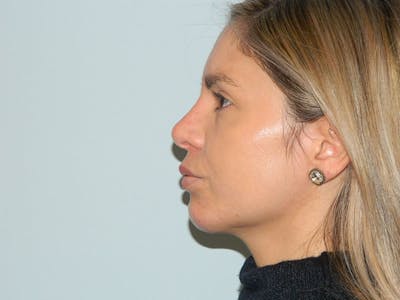 Non-Surgical Rhinoplasty and Injectable Fillers Before & After Gallery - Patient 133066526 - Image 2
