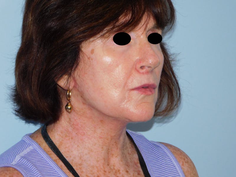 Facelift Before & After Gallery - Patient 133066535 - Image 2