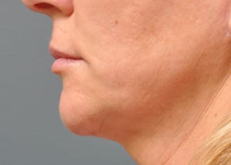 Ultherapy Before & After Gallery - Patient 133066524 - Image 2
