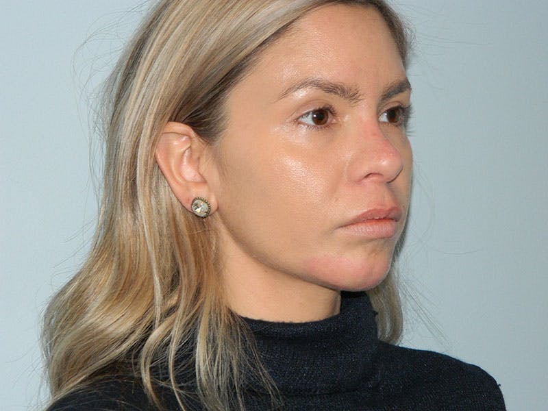 Non-Surgical Rhinoplasty and Injectable Fillers Before & After Gallery - Patient 133066526 - Image 3