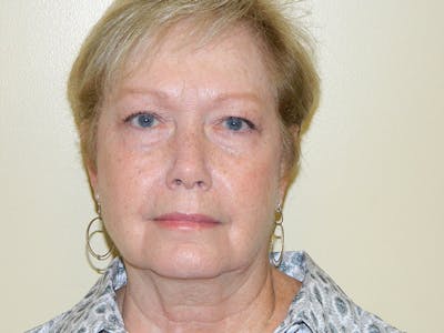 Mini-Facelift Before & After Gallery - Patient 133066532 - Image 1