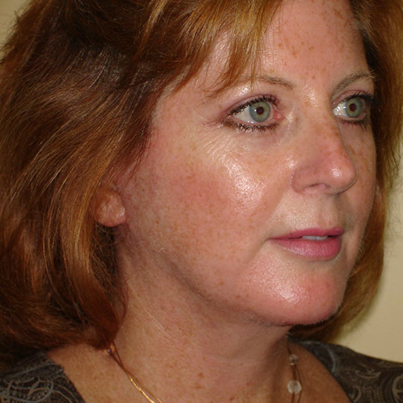 Chin Augmentation Before & After Gallery - Patient 133066536 - Image 2